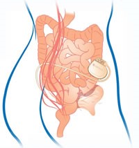 drawing of the bowel and interstim